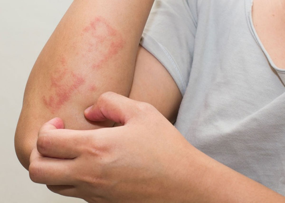 Persona con alergia piel