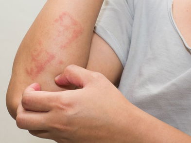 Las alergias alimentarias provocan reacciones en la piel