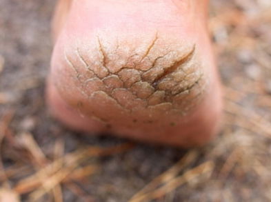 Cómo solucionar el problema de los talones agrietados