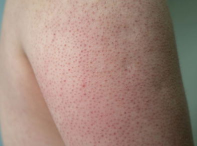 Remedios naturales para la queratosis pilaris