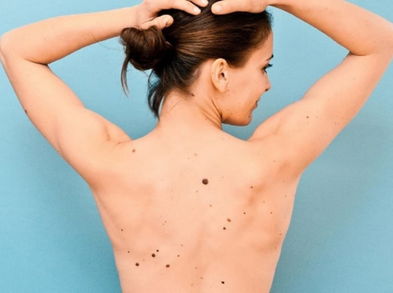 Cómo eliminar los lunares de manera eficaz